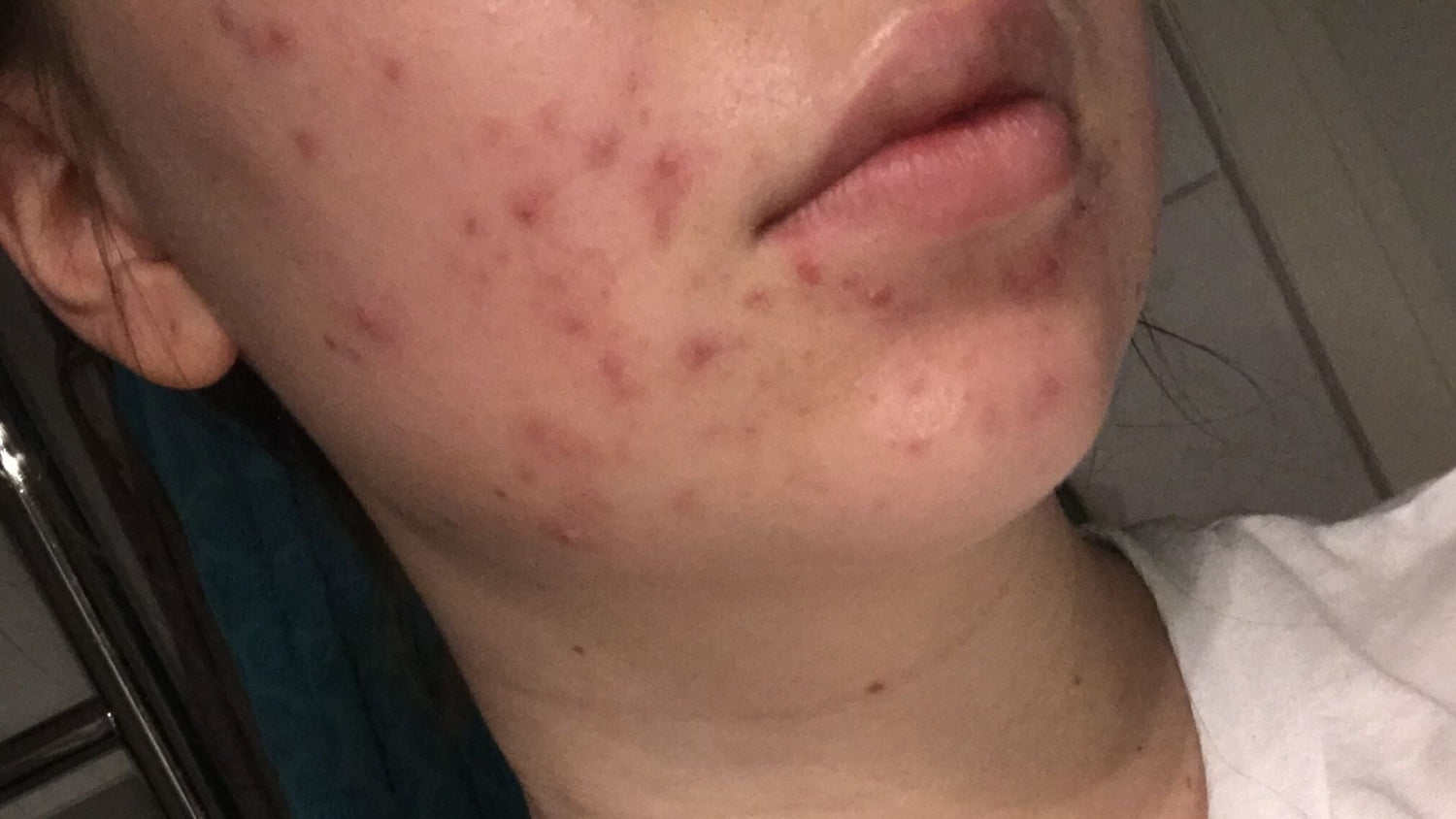 CBD treats acne and soothes the skin without drying it out